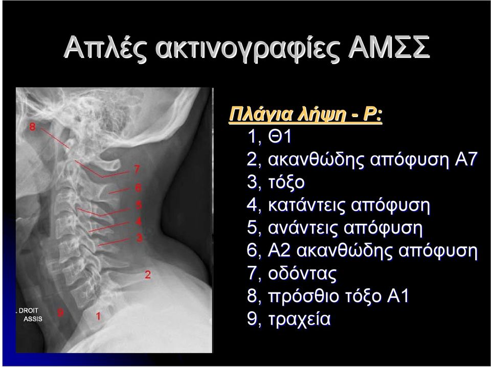 κατάντεις απόφυση 5, ανάντεις απόφυση 6, Α2