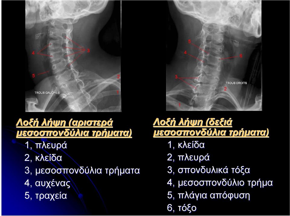 λήψη (δεξιά μεσοσπονδύλια τρήματα) 1, κλείδα 2, πλευρά 3,