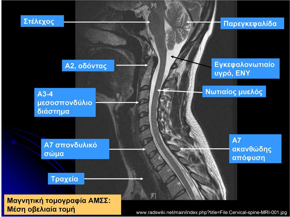 ακανθώδης απόφυση Τραχεία Μαγνητική τομογραφία ΑΜΣΣ: Μέση οβελιαία