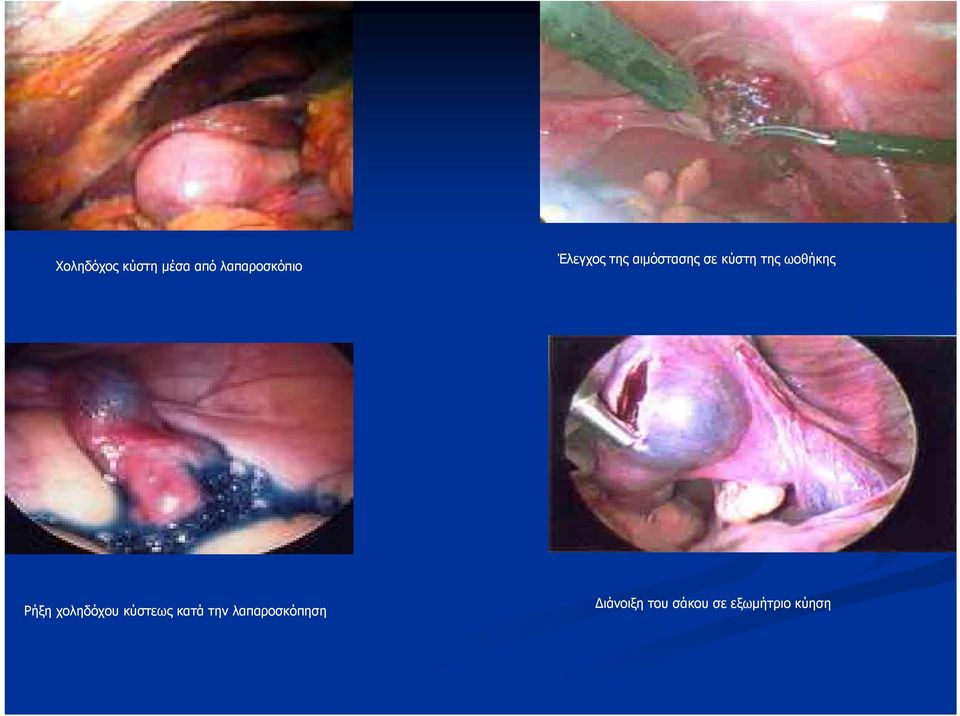 ωοθήκης Ρήξη χοληδόχου κύστεως κατά την