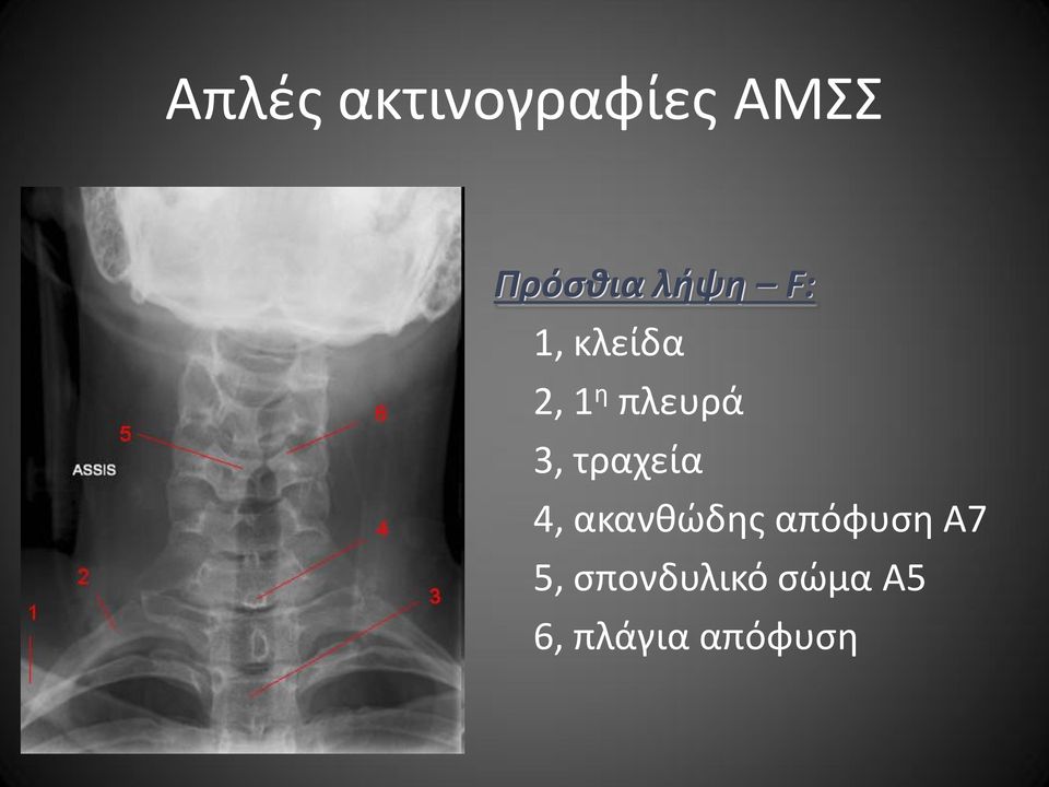 τραχεία 4, ακανθώδης απόφυση Α7 5,
