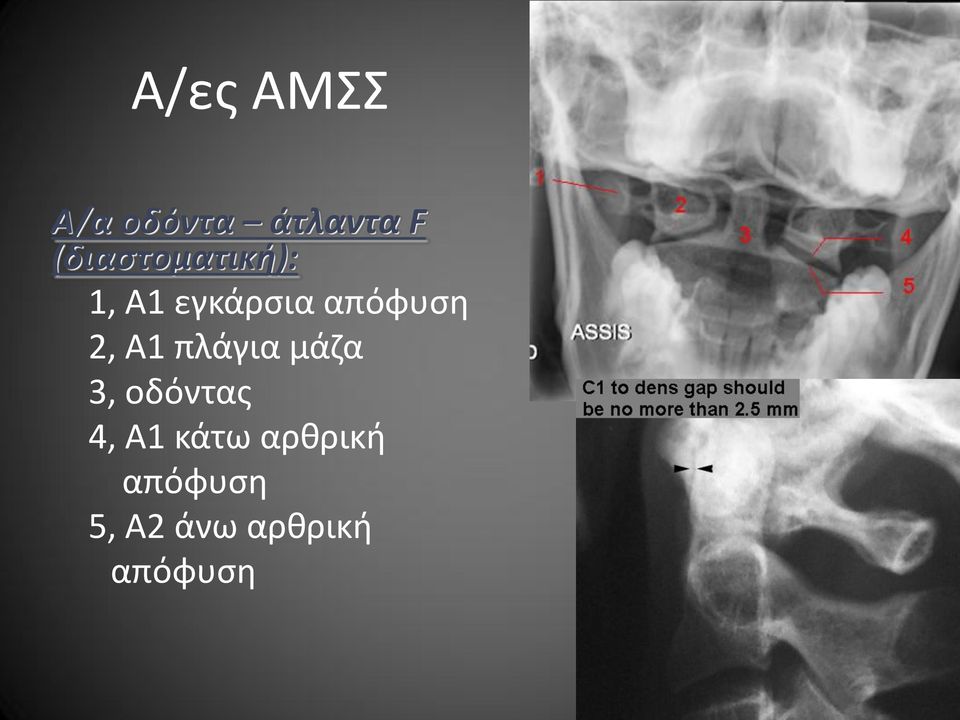 απόφυση 2, Α1 πλάγια μάζα 3, οδόντας