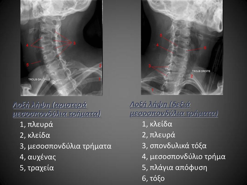 λήψη (δεξιά μεσοσπονδύλια τρήματα) 1, κλείδα 2, πλευρά 3,
