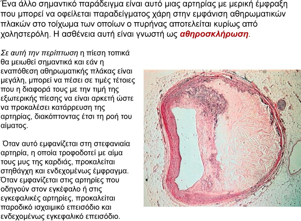 Σε αυτή την περίπτωση η πίεση τοπικά θα μειωθεί σημαντικά και εάν η εναπόθεση αθηρωματικής πλάκας είναι μεγάλη, μπορεί να πέσει σε τιμές τέτοιες που η διαφορά τους με την τιμή της εξωτερικής πίεσης