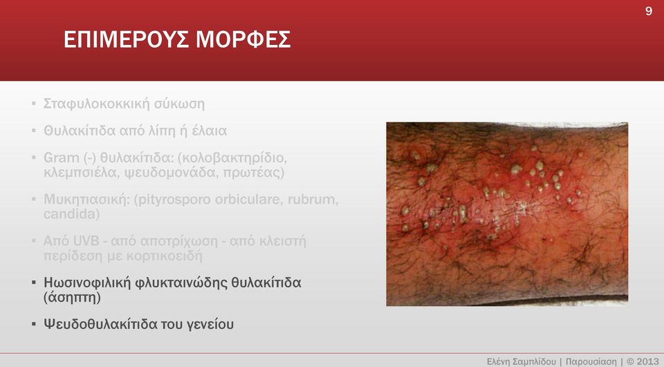 (pityrosporo orbiculare, rubrum, candida) Από UVB - από αποτρίχωση - από κλειστή