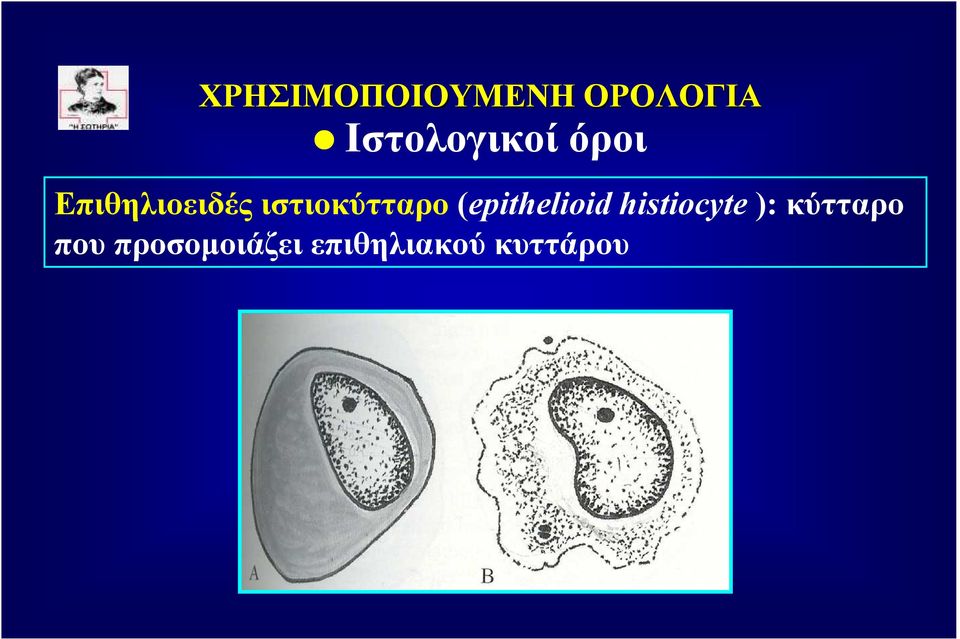 ιστιοκύτταρο (epithelioid