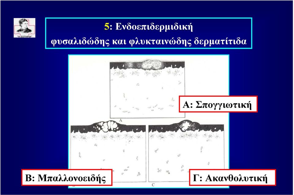 φλυκταινώδης δερµατίτιδα