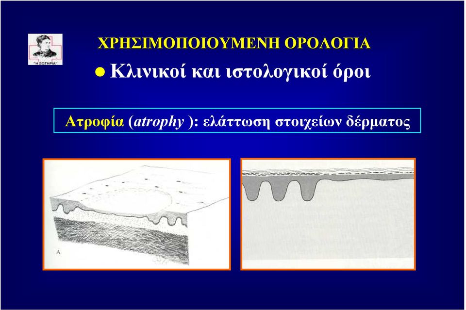 όροι Ατροφία (atrophy ):