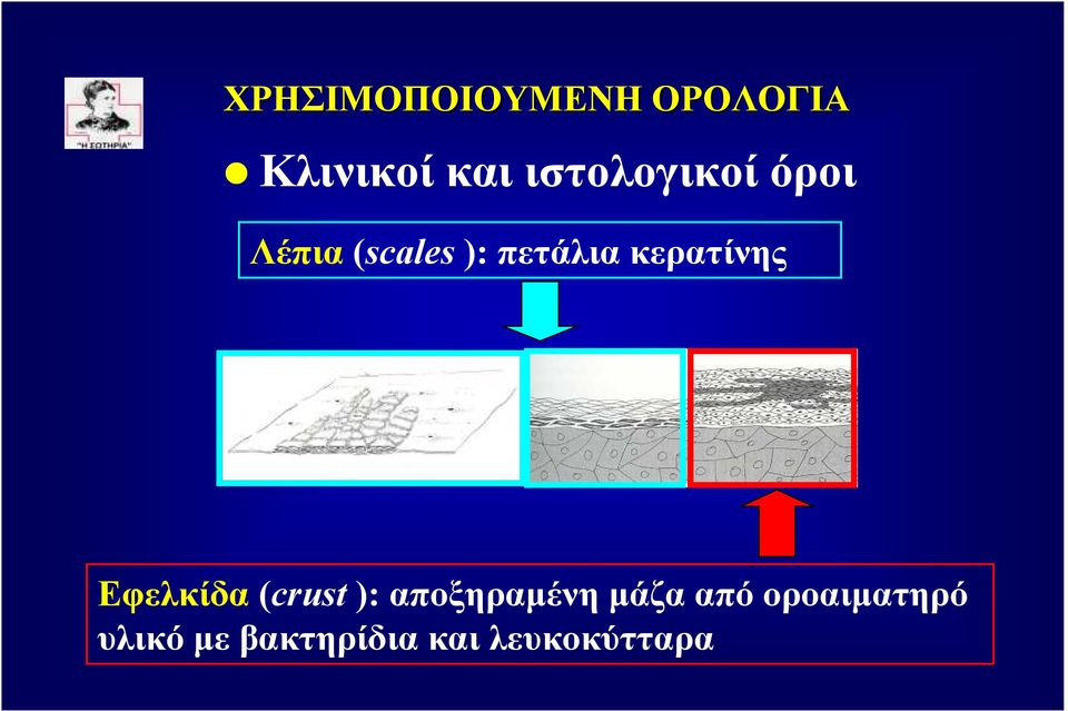 κερατίνης Εφελκίδα (crust ): αποξηραµένη