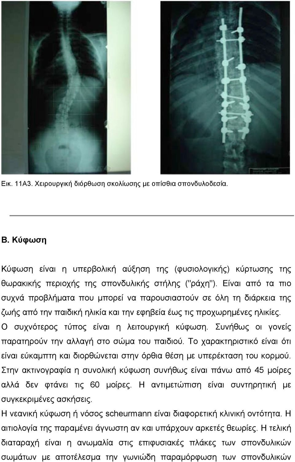 Ο συχνότερος τύπος είναι η λειτουργική κύφωση. Συνήθως οι γονείς παρατηρούν την αλλαγή στο σώµα του παιδιού.