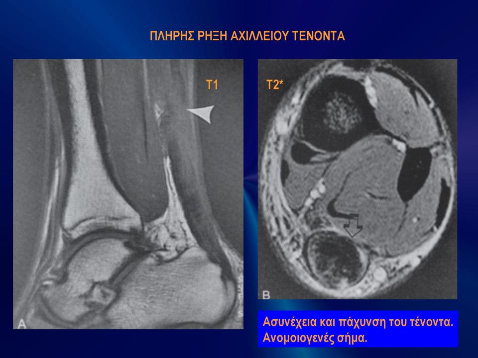 Ασυνέχεια και πάχυνση