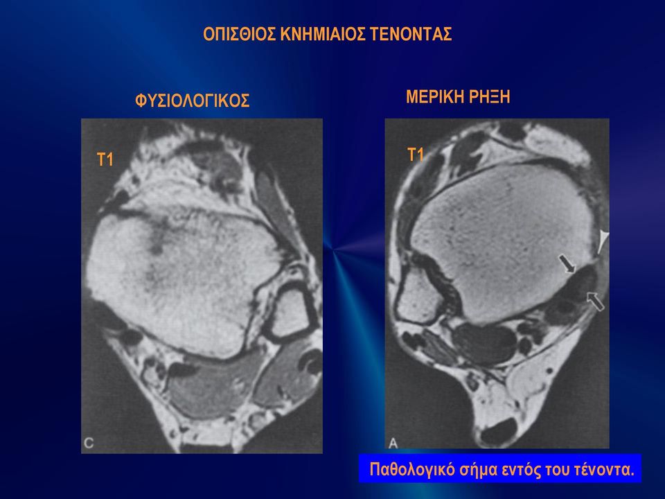 ΜΕΡΙΚΗ ΡΗΞΗ Τ1 Τ1