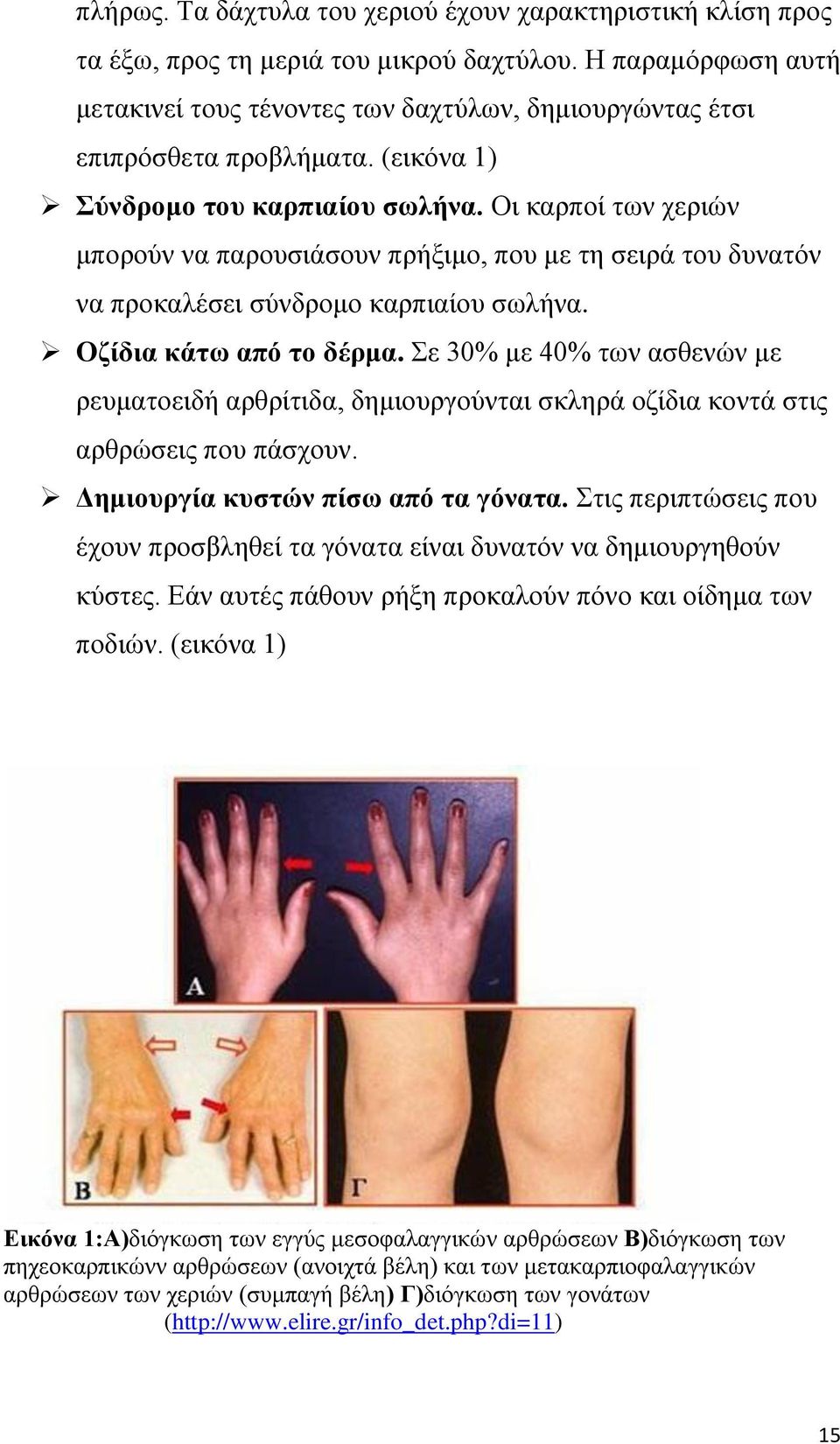 Οι καρποί των χεριών μπορούν να παρουσιάσουν πρήξιμο, που με τη σειρά του δυνατόν να προκαλέσει σύνδρομο καρπιαίου σωλήνα. Οζίδια κάτω από το δέρμα.