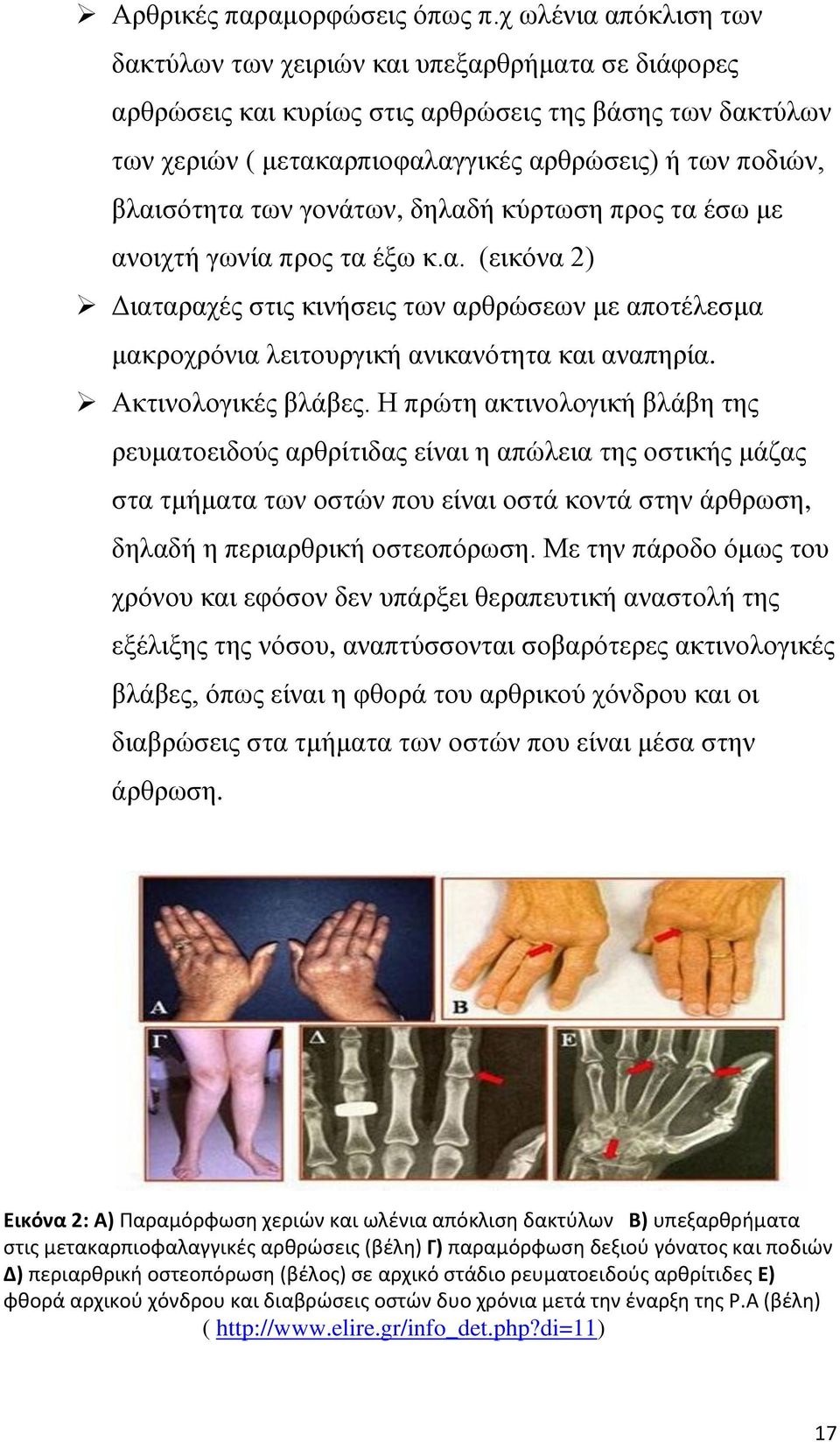 βλαισότητα των γονάτων, δηλαδή κύρτωση προς τα έσω με ανοιχτή γωνία προς τα έξω κ.α. (εικόνα 2) Διαταραχές στις κινήσεις των αρθρώσεων με αποτέλεσμα μακροχρόνια λειτουργική ανικανότητα και αναπηρία.