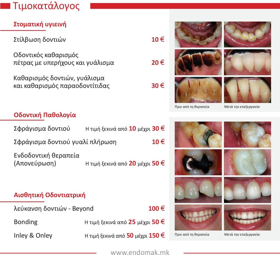Ενδοδοντική θεραπεία (Απονεύρωση) Η τιμή ξεκινά από 20 μέχρι 50 * Πριν από τη θεραπεία Μετά την επεξεργασία Αισθητική Οδοντιατρική λεύκανση δοντιών