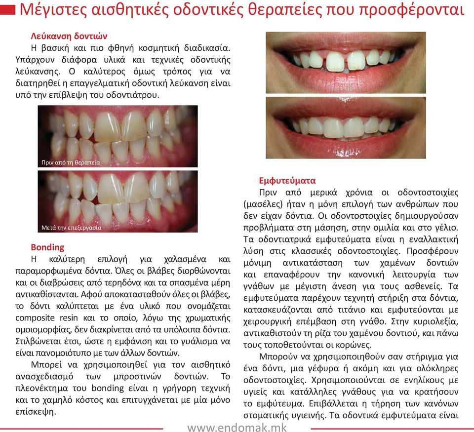 Πριν από τη θεραπεία Μετά την επεξεργασία Bonding Η καλύτερη επιλογή για χαλασμένα και παραμορφωμένα δόντια.