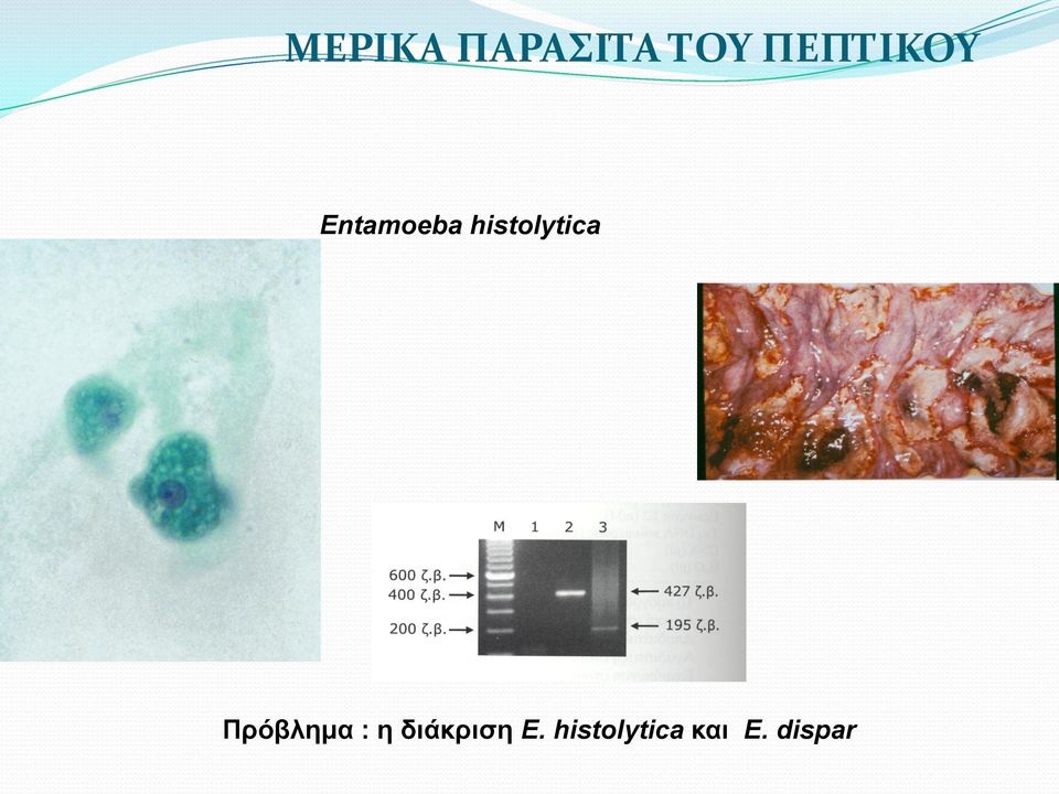 histolytica Πρόβλημα : η