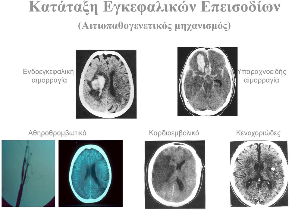 Ενδοεγκεφαλική αιμορραγία Υπαραχνοειδής