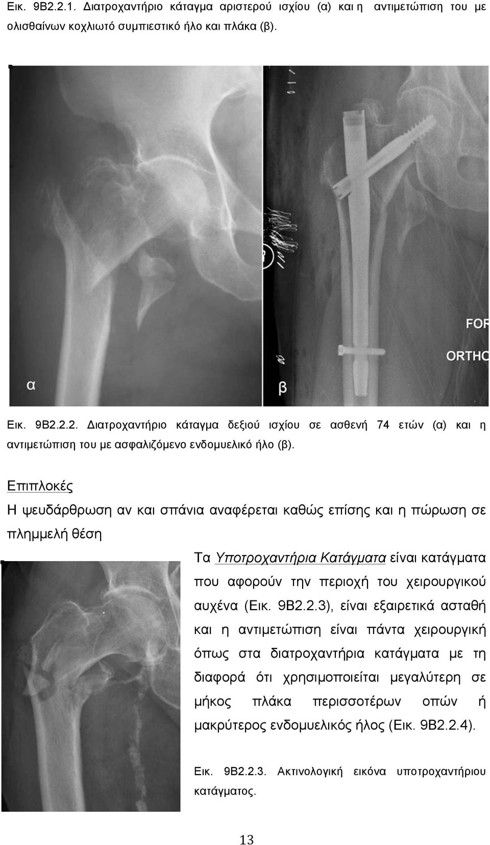 9Β2.2.3), είναι εξαιρετικά ασταθή και η αντιµετώπιση είναι πάντα χειρουργική όπως στα διατροχαντήρια κατάγµατα µε τη διαφορά ότι χρησιµοποιείται µεγαλύτερη σε µήκος πλάκα περισσοτέρων οπών