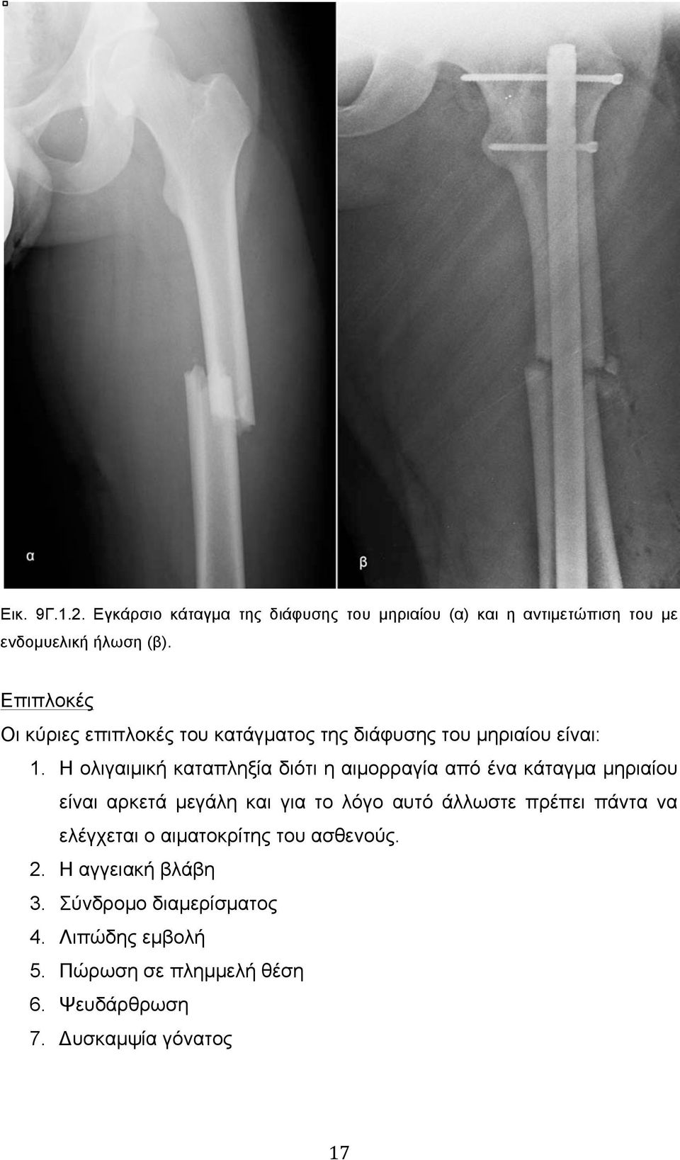 Η ολιγαιµική καταπληξία διότι η αιµορραγία από ένα κάταγµα µηριαίου είναι αρκετά µεγάλη και για το λόγο αυτό άλλωστε