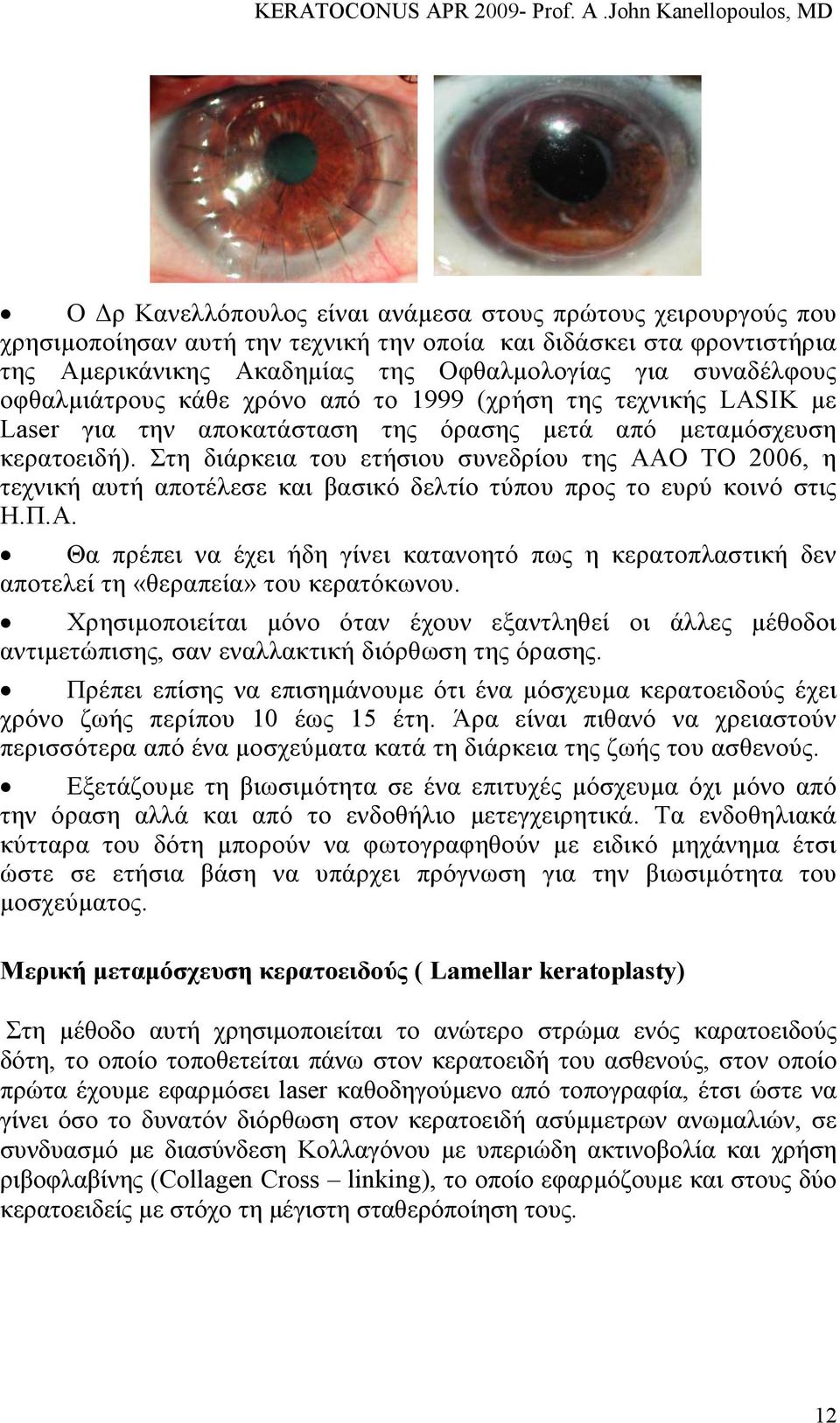 Στη διάρκεια του ετήσιου συνεδρίου της ΑΑΟ ΤΟ 2006, η τεχνική αυτή αποτέλεσε και βασικό δελτίο τύπου προς το ευρύ κοινό στις Η.Π.Α. Θα πρέπει να έχει ήδη γίνει κατανοητό πως η κερατοπλαστική δεν αποτελεί τη «θεραπεία» του κερατόκωνου.