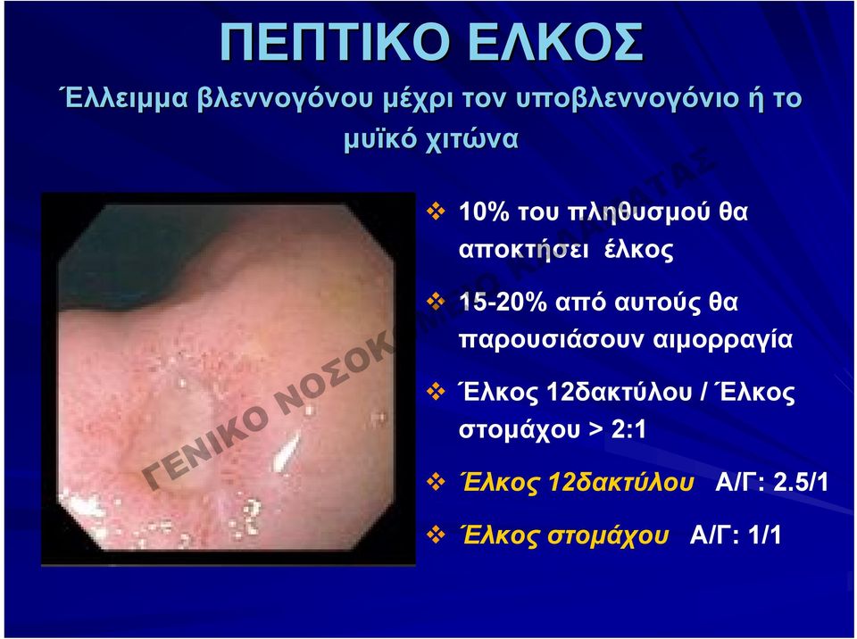 από αυτούς θα παρουσιάσουν αιμορραγία Έλκος 12δακτύλου / Έλκος