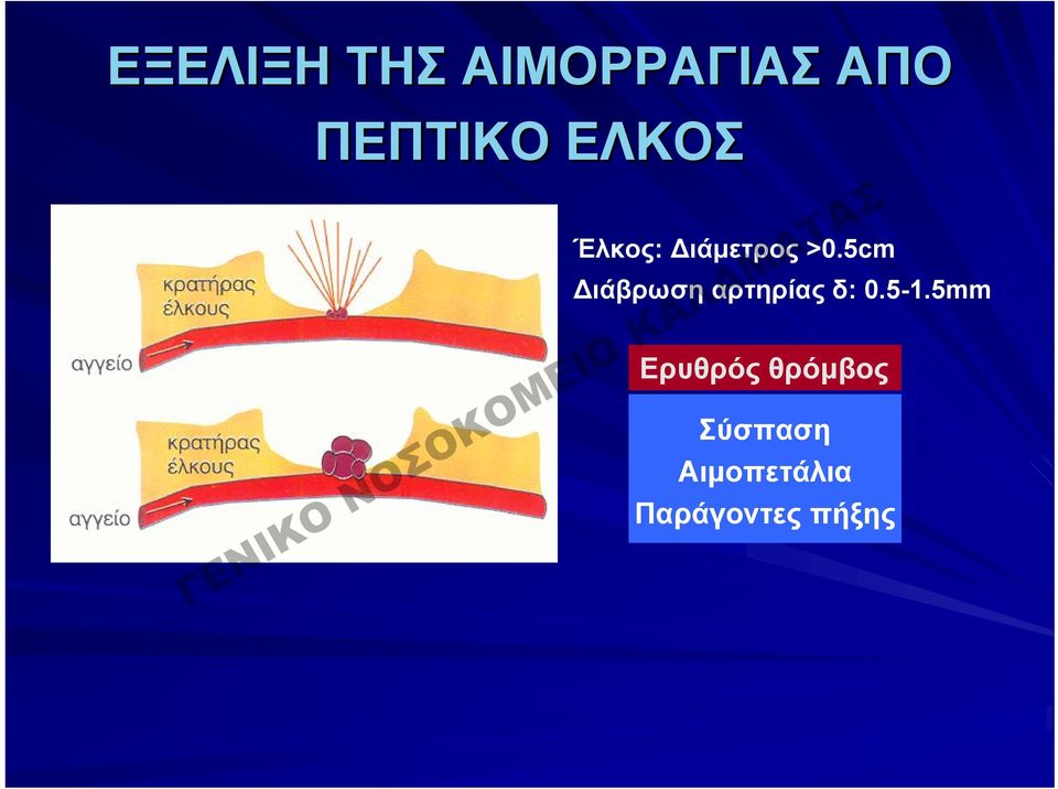 5cm Διάβρωση αρτηρίας δ: 0.5-1.