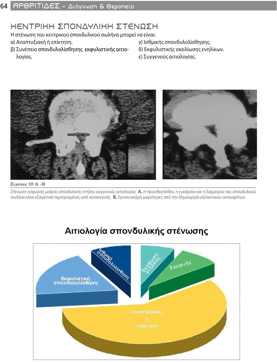 ε) Συγγενούς αιτιολογίας. Εικόνες 19 Α -Β Στένωση οσφυϊκής μοίρας σπονδυλικής στήλης συγγενούς αιτιολογίας Α.