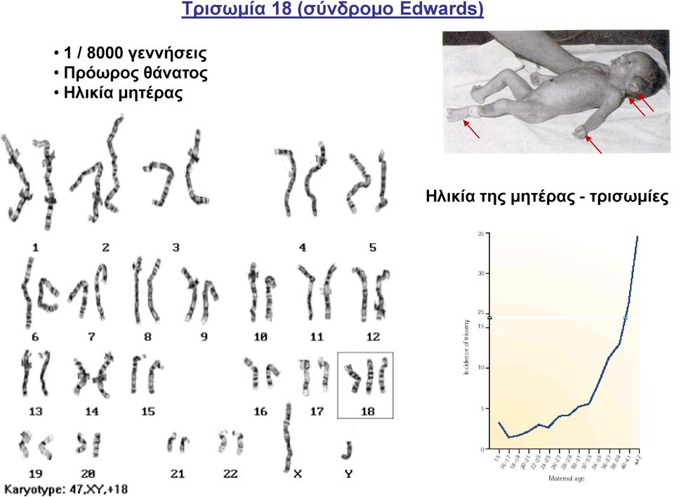 Τρισωμία 18 (σύνδρομο