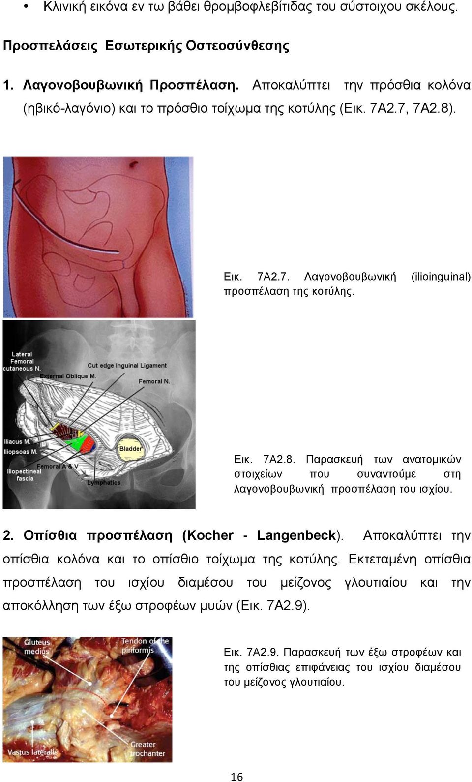 . Εικ. 7Α2.7. Λαγονοβουβωνική (ilioinguinal) προσπέλαση της κοτύλης. Εικ. 7Α2.8. Παρασκευή των ανατοµικών στοιχείων που συναντούµε στη λαγονοβουβωνική προσπέλαση του ισχίου. 2.