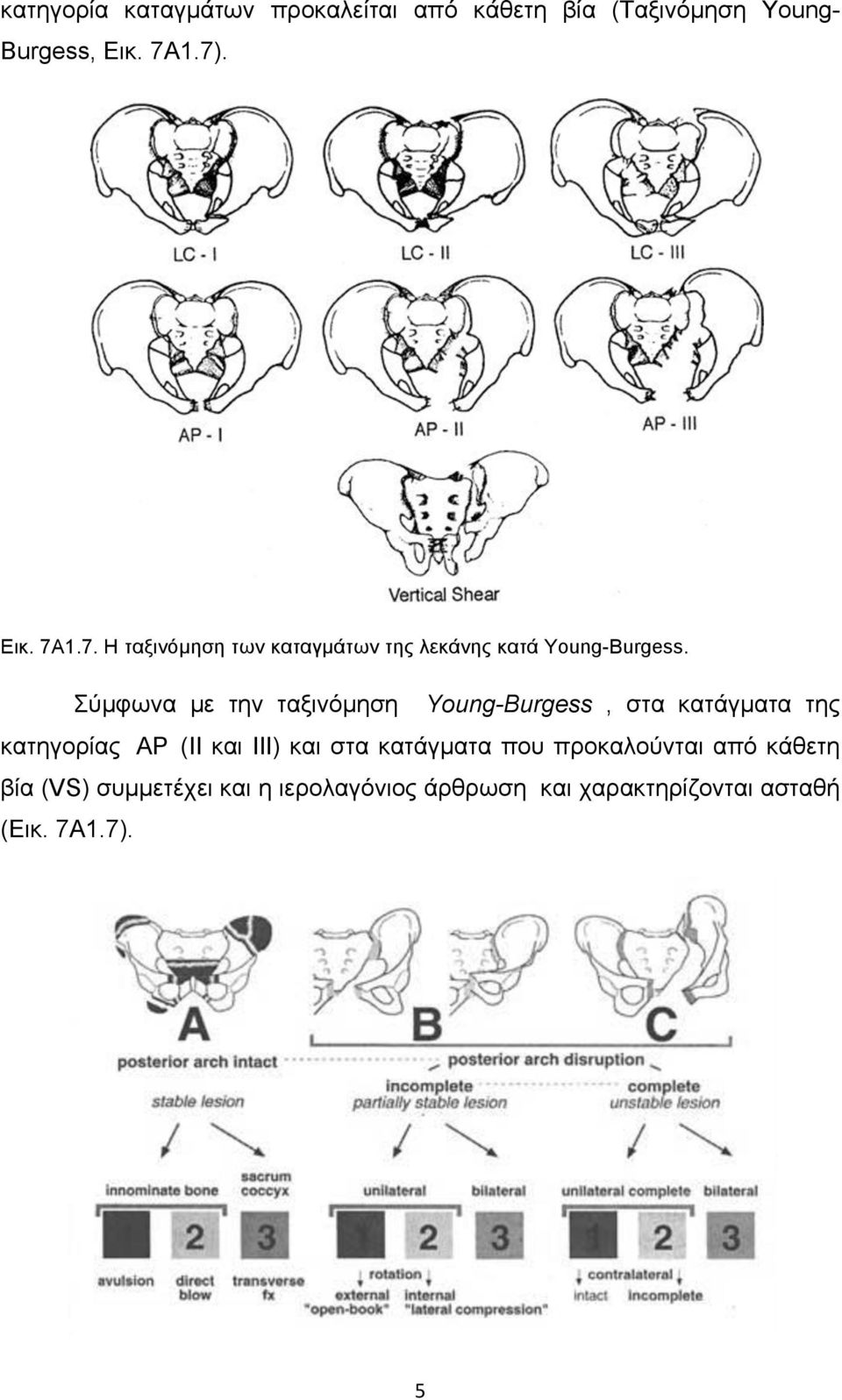 Σύµφωνα µε την ταξινόµηση Young-Burgess, στα κατάγµατα της κατηγορίας ΑΡ (ΙΙ και ΙΙΙ) και στα