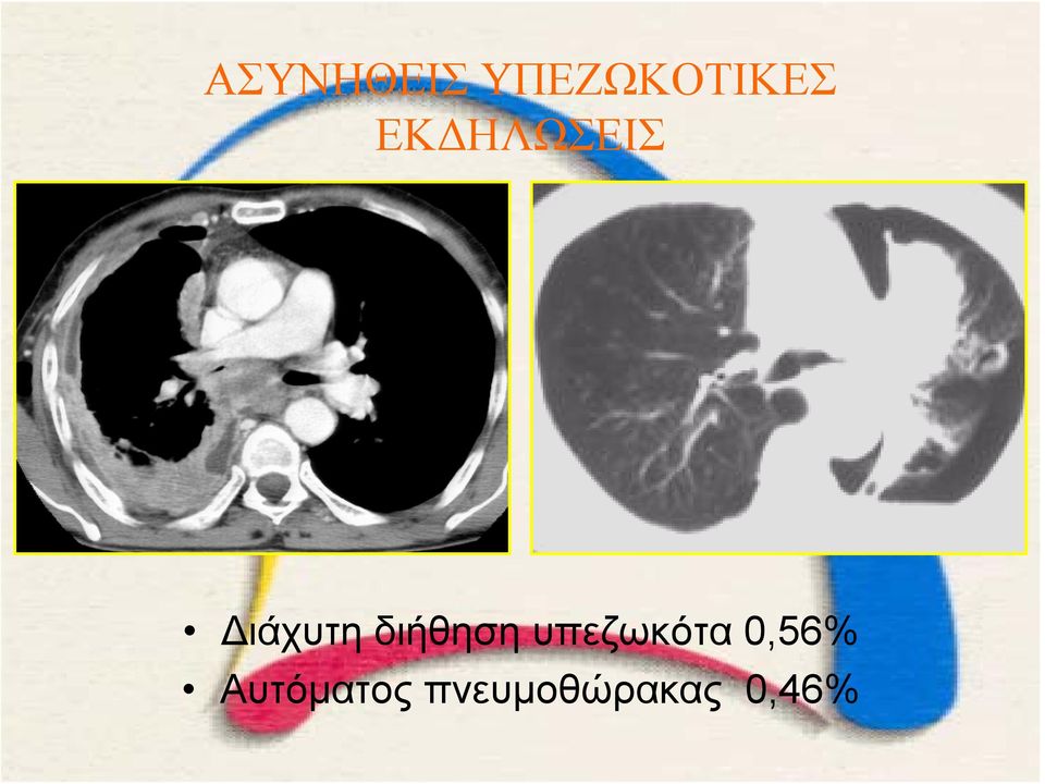 διήθηση υπεζωκότα 0,56%