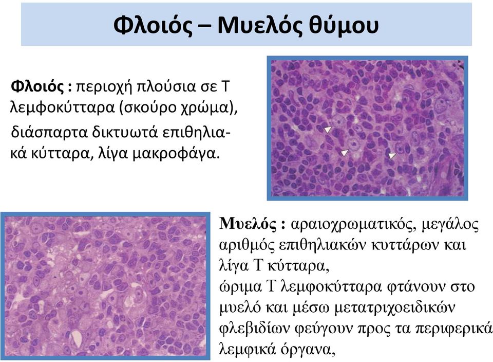 Μυελός : αραιοχρωματικός, μεγάλος αριθμός επιθηλιακών κυττάρων και λίγα Τ κύτταρα,