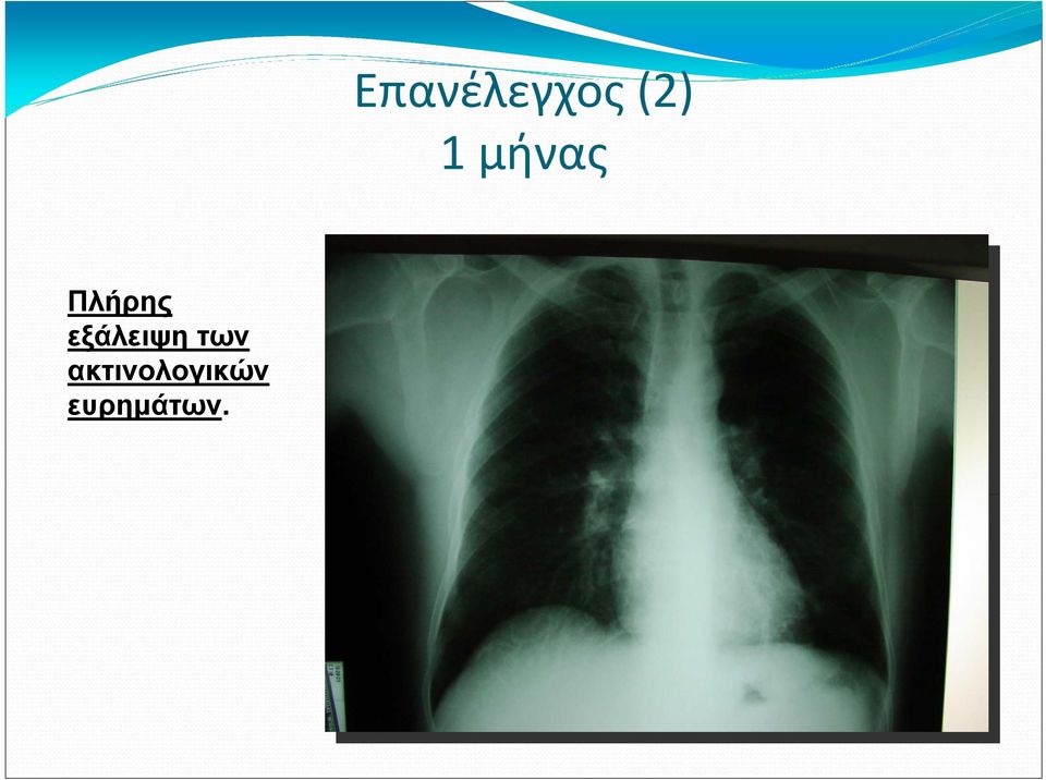 εξάλειψη των