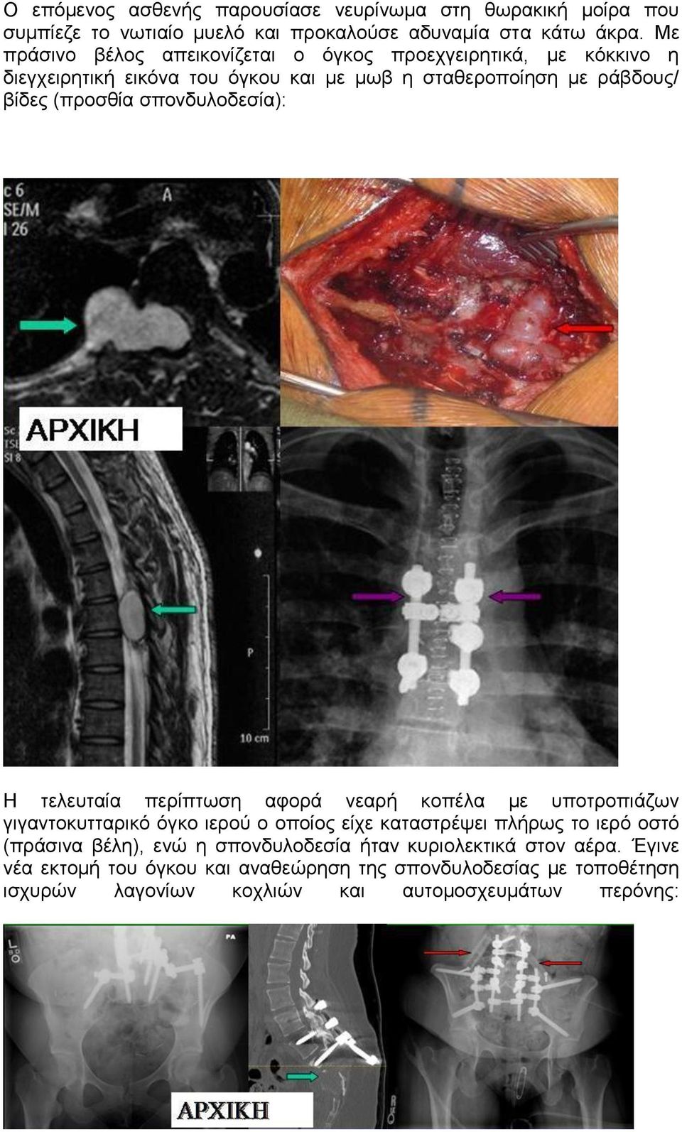 σπονδυλοδεσία): Η τελευταία περίπτωση αφορά νεαρή κοπέλα με υποτροπιάζων γιγαντοκυτταρικό όγκο ιερού ο οποίος είχε καταστρέψει πλήρως το ιερό οστό (πράσινα