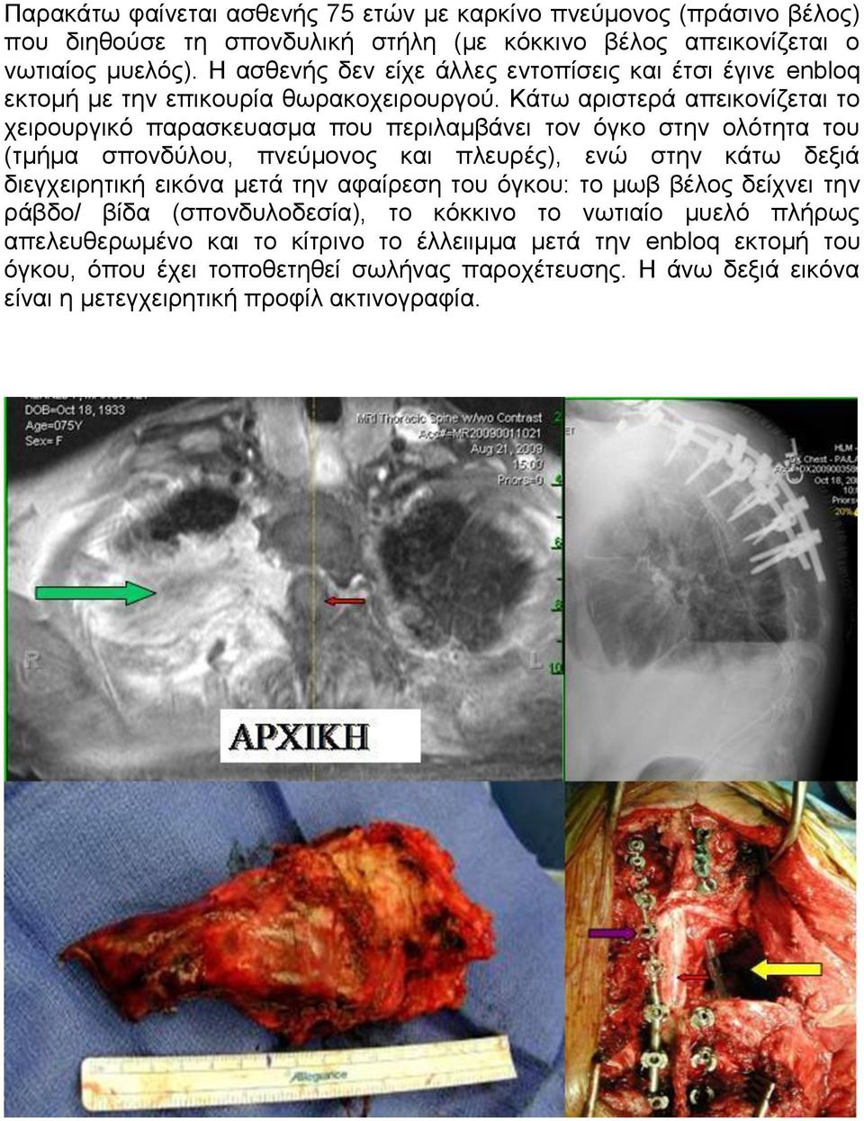 Κάτω αριστερά απεικονίζεται το χειρουργικό παρασκευασμα που περιλαμβάνει τον όγκο στην ολότητα του (τμήμα σπονδύλου, πνεύμονος και πλευρές), ενώ στην κάτω δεξιά διεγχειρητική εικόνα