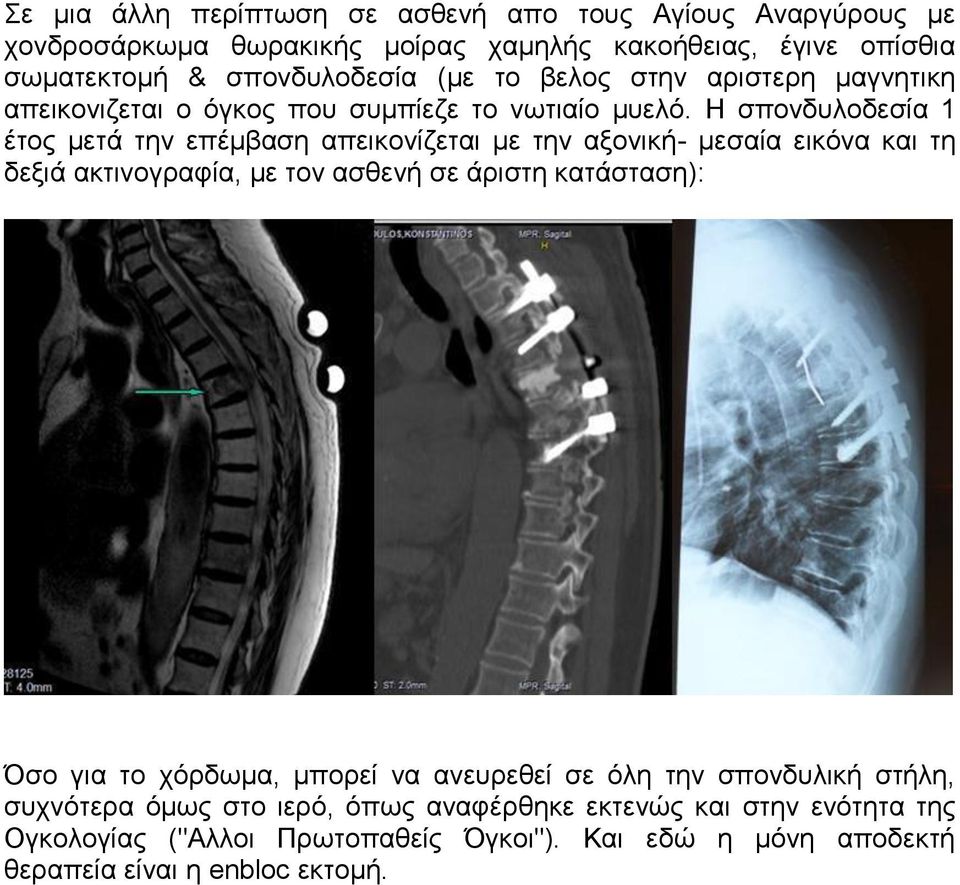 H σπονδυλοδεσία 1 έτος μετά την επέμβαση απεικονίζεται με την αξονική- μεσαία εικόνα και τη δεξιά ακτινογραφία, με τον ασθενή σε άριστη κατάσταση): Όσο για