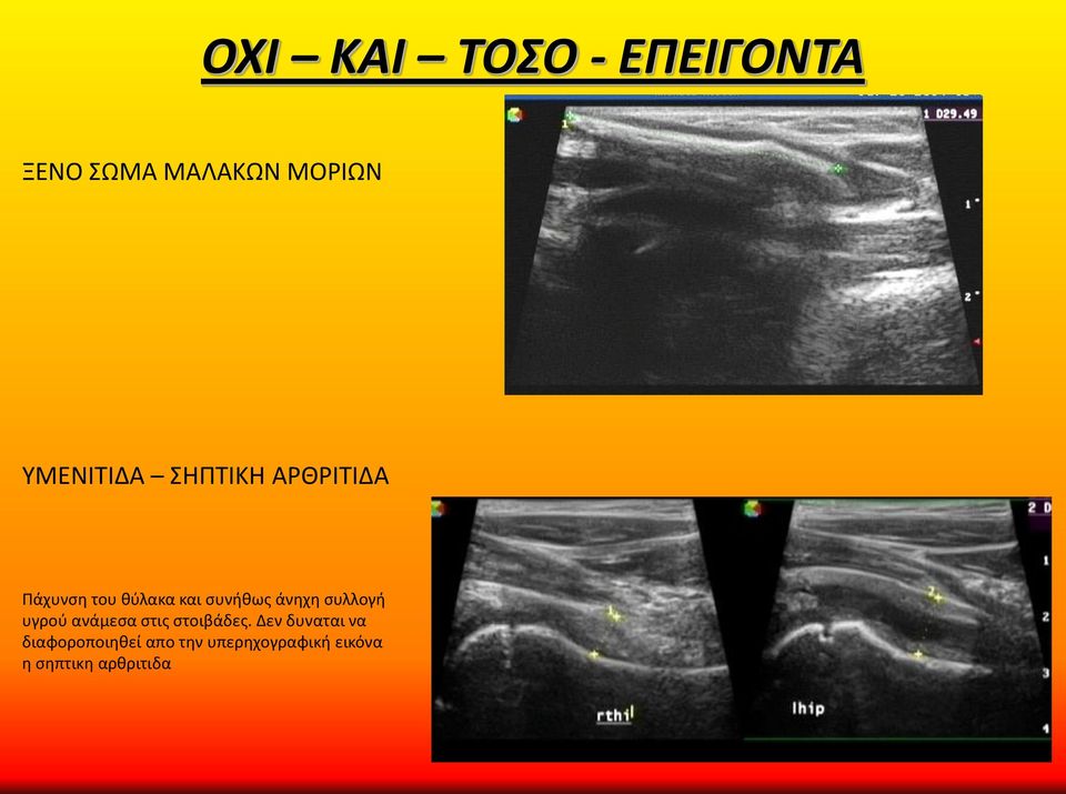 συνήθως άνηχη συλλογή υγρού ανάμεσα στις στοιβάδες.