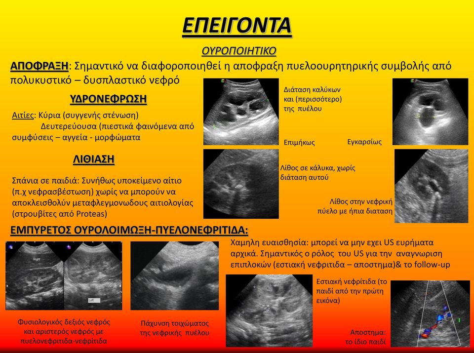 χ νεφρασβέστωση) χωρίς να μπορούν να αποκλεισθολύν μεταφλεγμονωδους αιτιολογίας (στρουβίτες από Proteas) ΕΜΠΥΡΕΤΟΣ ΟΥΡΟΛΟΙΜΩΞΗ-ΠΥΕΛΟΝΕΦΡΙΤΙΔΑ: Διάταση καλύκων και (περισσότερο) της πυέλου Επιμήκως