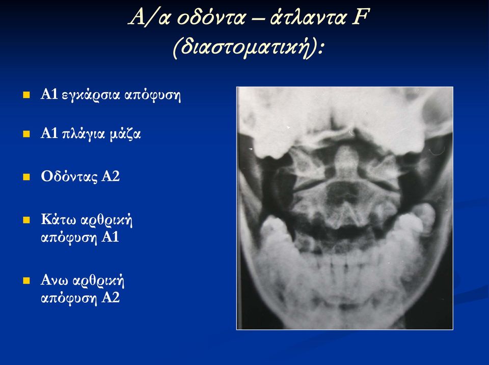 απόφυση Α1 πλάγια μάζα Οδόντας