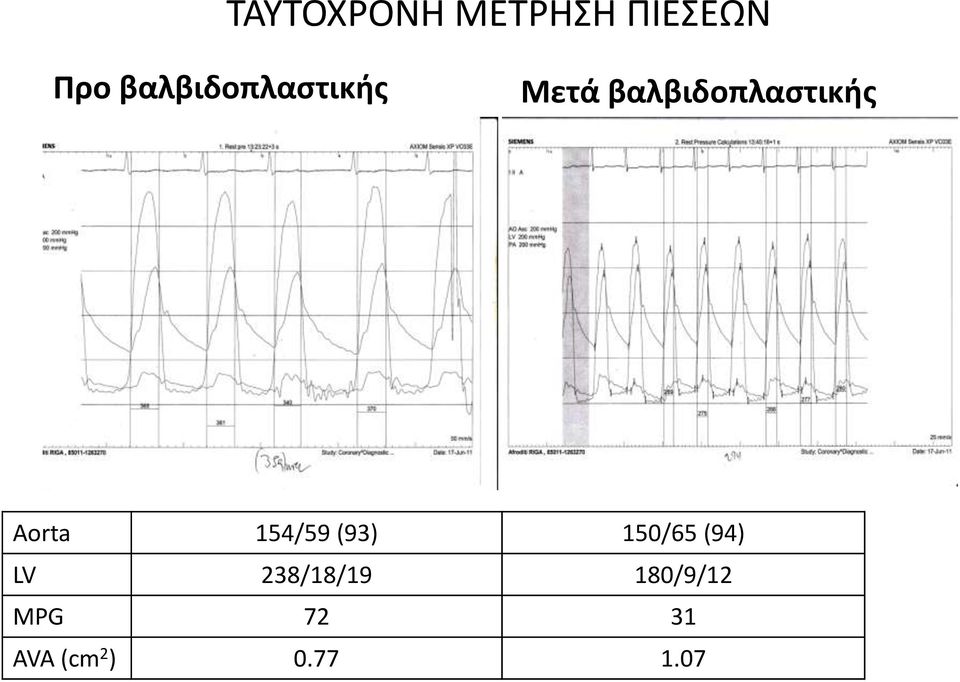 Aorta 154/59 (93) 150/65 (94) LV