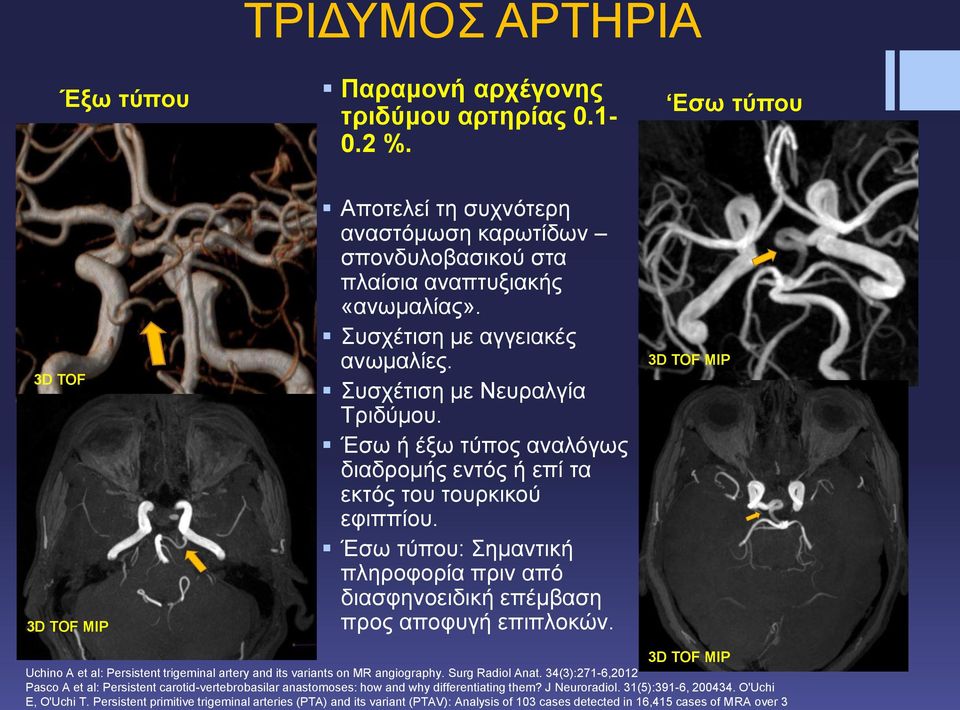 Έσω τύπου: Σημαντική πληροφορία πριν από διασφηνοειδική επέμβαση προς αποφυγή επιπλοκών. MIP MIP Uchino A et al: Persistent trigeminal artery and its variants on MR angiography. Surg Radiol Anat.