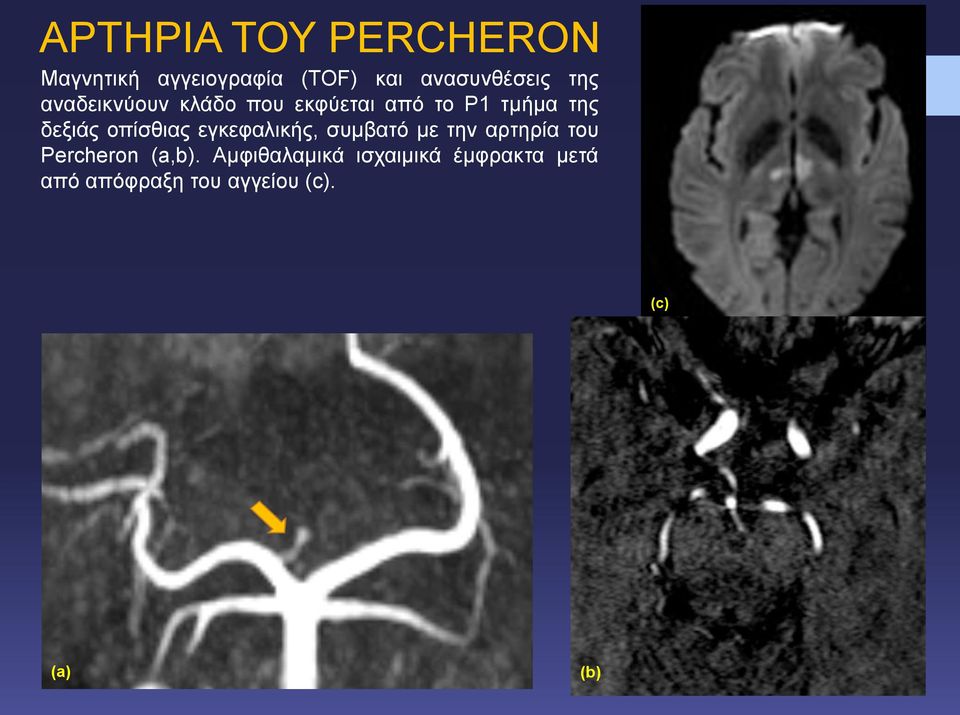 οπίσθιας εγκεφαλικής, συμβατό με την αρτηρία του Percheron (a,b).