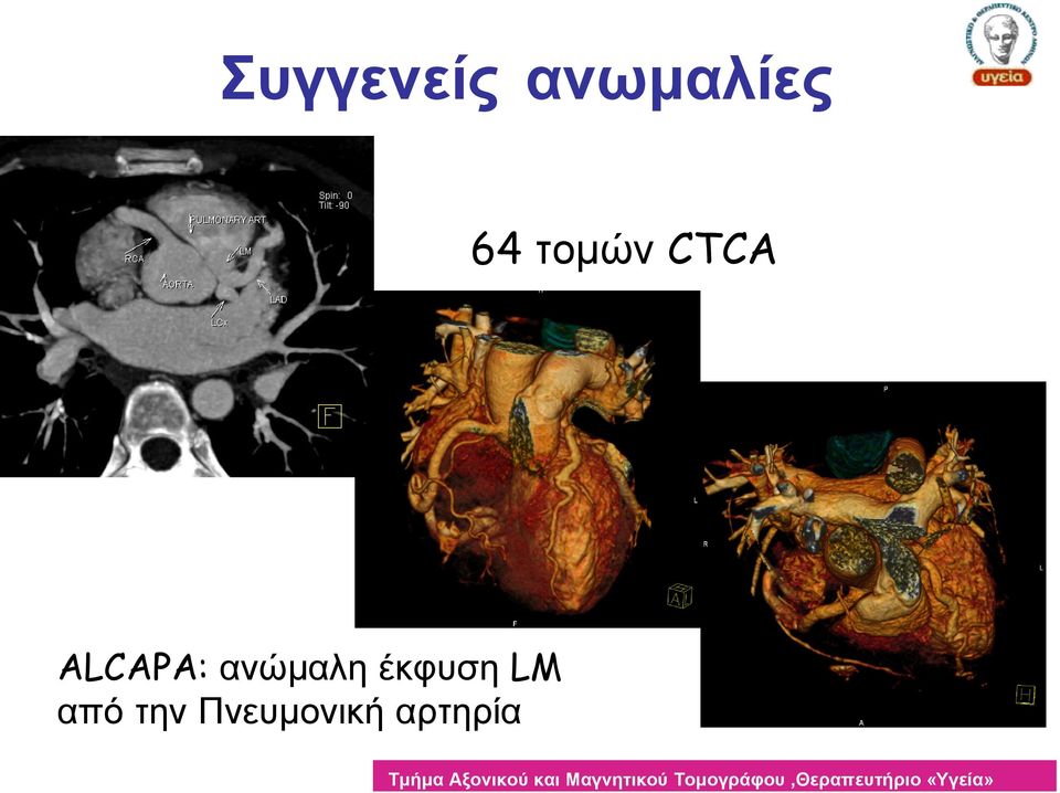 ανώμαλη έκφυση LM από