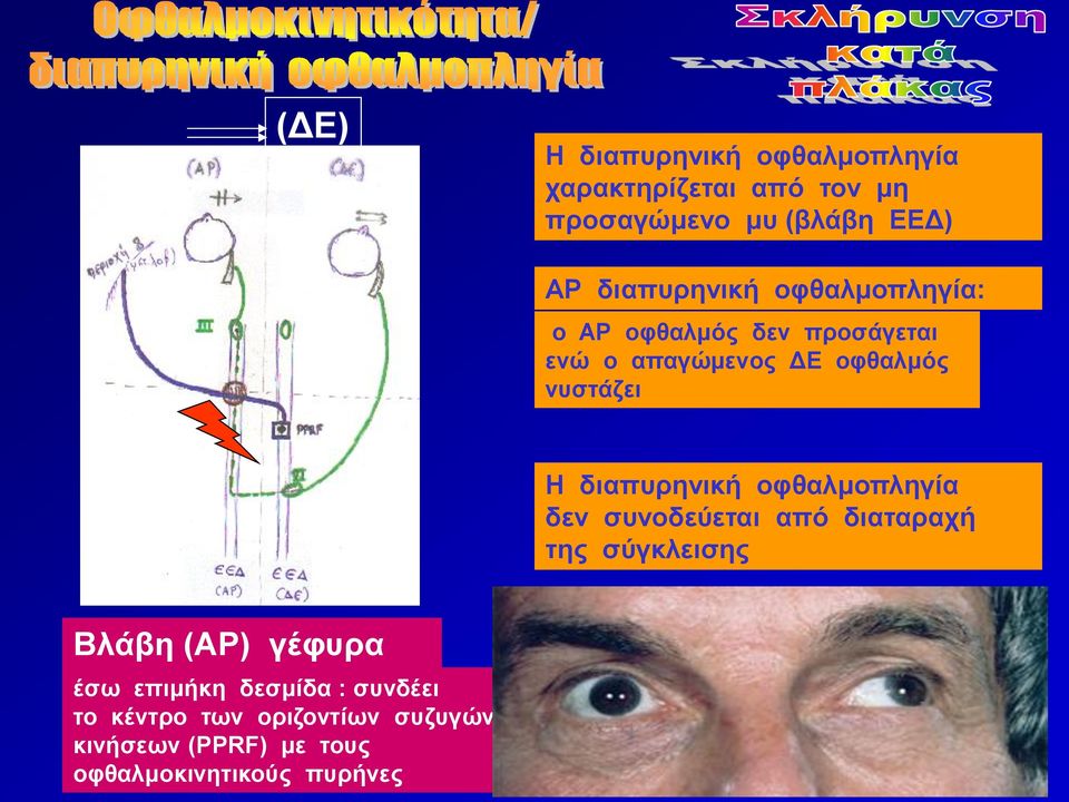 διαπυρηνική οφθαλμοπληγία δεν συνοδεύεται από διαταραχή της σύγκλεισης Βλάβη (ΑΡ) γέφυρα έσω