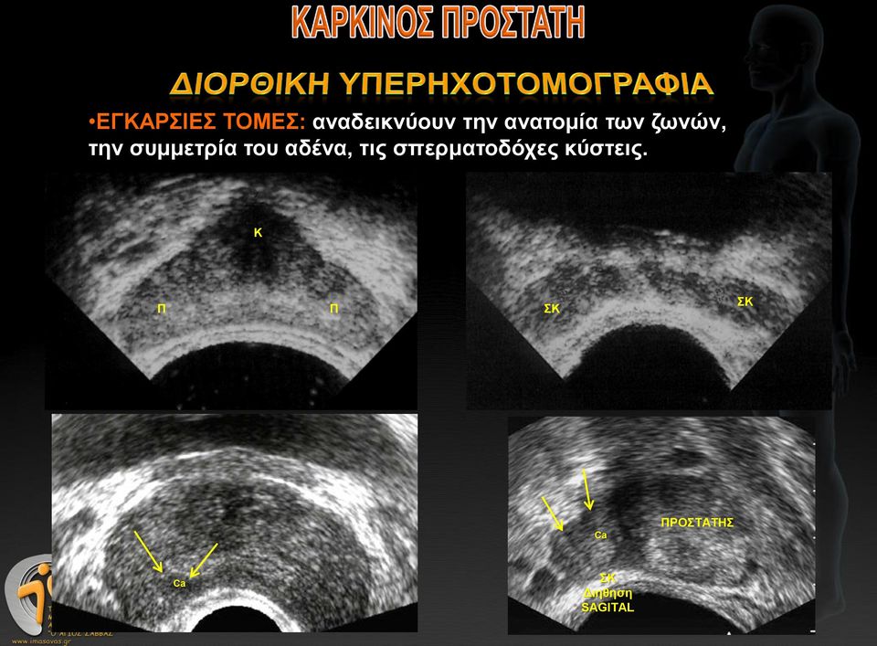 αδένα, τις σπερματοδόχες κύστεις.