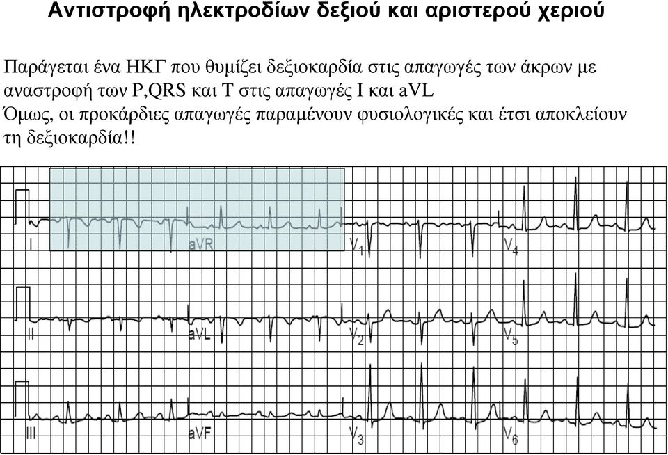 των P,QRS και T στις απαγωγές I και avl Όµως, οι προκάρδιες