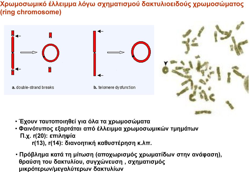 λπ. Πρόβλημα κατά τη μίτωση (αποχωρισμός χρωματίδων στην ανάφαση), θραύση του δακτυλίου,