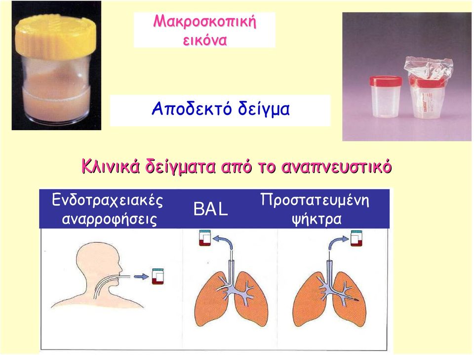 Ενδοτραχειακές αναρροφήσεις BAL