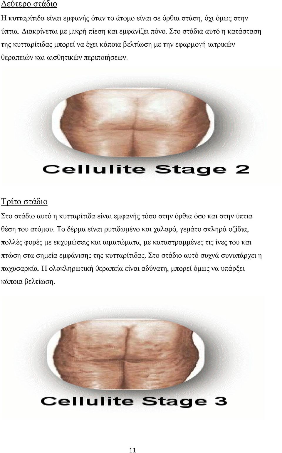 Τρίτο στάδιο Στο στάδιο αυτό η κυτταρίτιδα είναι εμφανής τόσο στην όρθια όσο και στην ύπτια θέση του ατόμου.